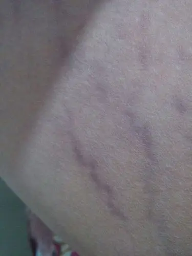 如图,两大腿内侧都这样,体重三个月涨了20斤,以前体重一直没变过,是不