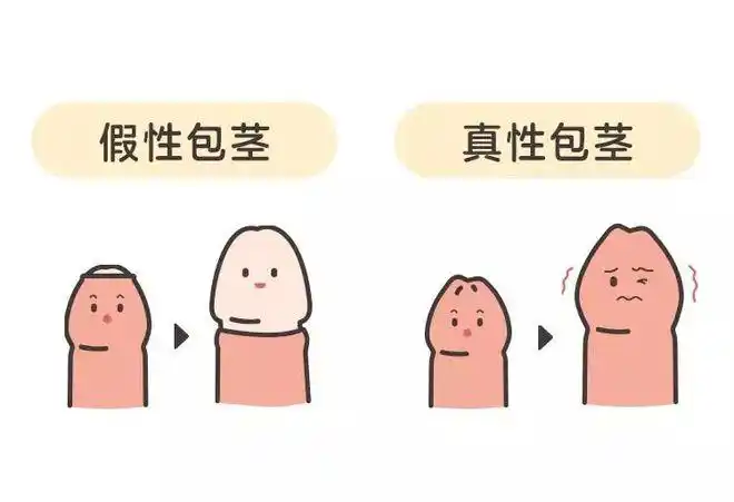 假性包茎就是包皮过长但小鸡鸡能在勃起时「出人头地」包皮也可以用手