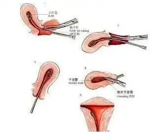 1,取环手术是怎么取的?