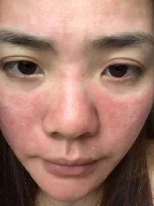 面膜过敏后脸如何恢复 用了面膜脸上过敏了怎样才能尽快好