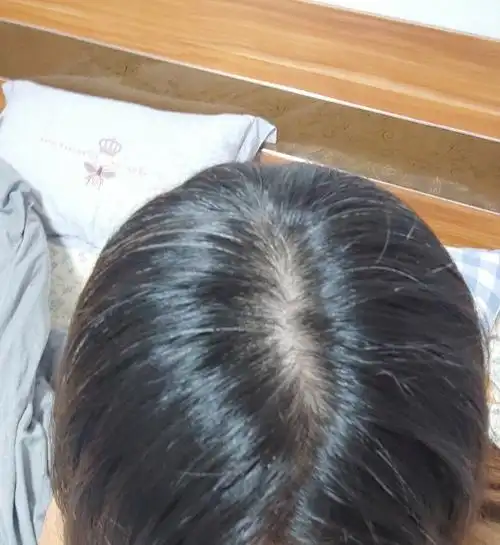 秃头秃顶白头发女士脱发白发照片秃顶长白头发图片头顶脱发图白发