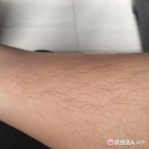 怀孕初期肚子上长毛毛就是男宝吗?