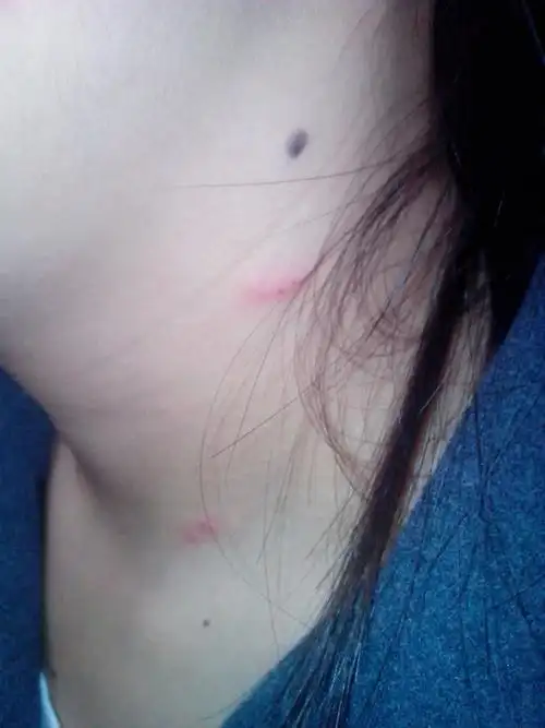 57 2013-11-04 22:01贾福义医师 回答: 病情分析: 您好,毛囊炎