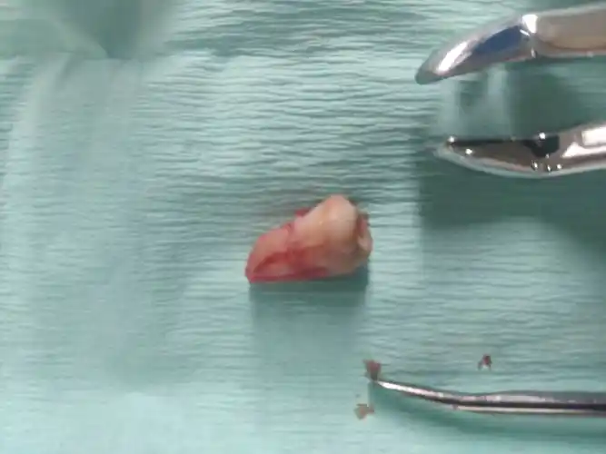 拔智齿了后面有智齿的图片谨慎看