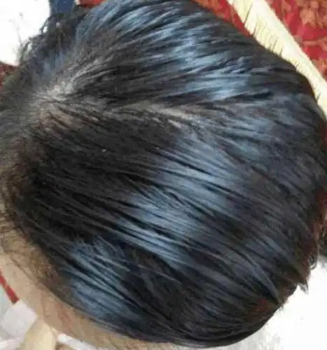 1,头发油腻,螨虫在头上爬来爬去,会对头皮的新陈代谢造成影响,使皮脂