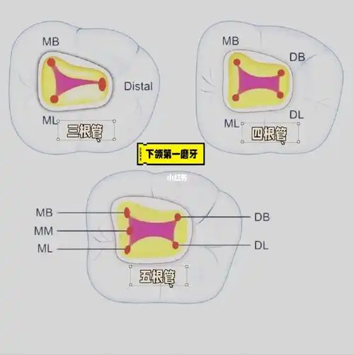 下颌第一磨牙三根管四根管五根管