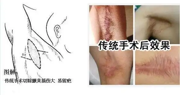 腋臭_治疗方法_手术_ - 好大夫在线