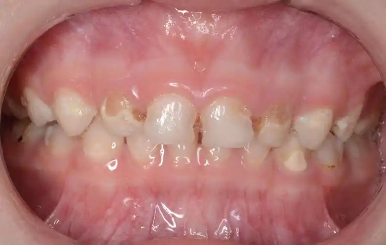 乳牙蛀牙要不要补