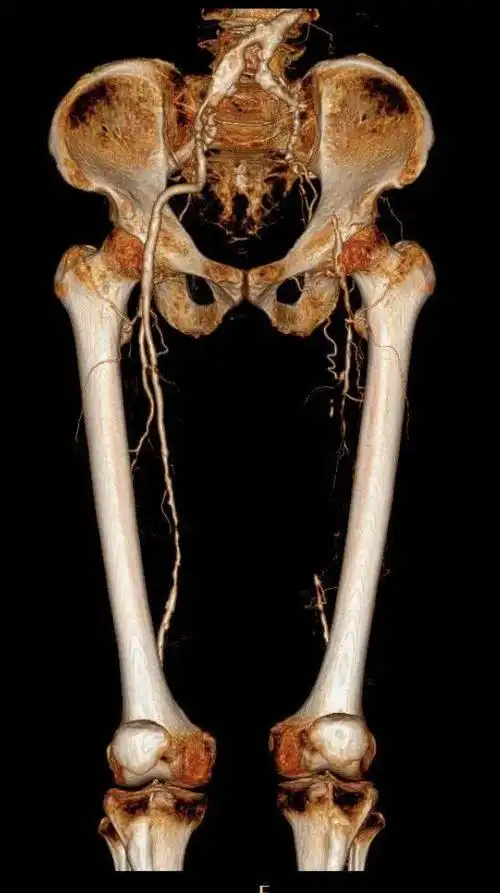 五院首例老人险被截肢的腿被一台复合手术保住了