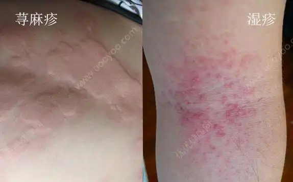 荨麻疹和湿疹一样吗荨麻疹和湿疹的区别有哪些图