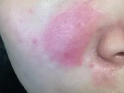 脸部过敏是很常见的问题,严重会引起瘙痒红肿,疼痛!