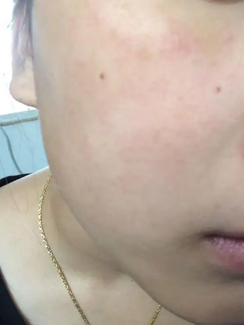 麻烦懂得都进来看看,我脸上不知道怎么了