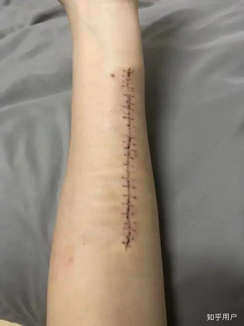 有切除纹身的经验分享吗