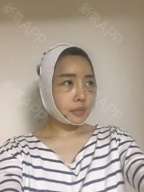 萨德木6拉皮手术提升术后第7天美丽日记_新氧整形