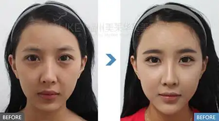 鼻子玻尿酸多久补一次