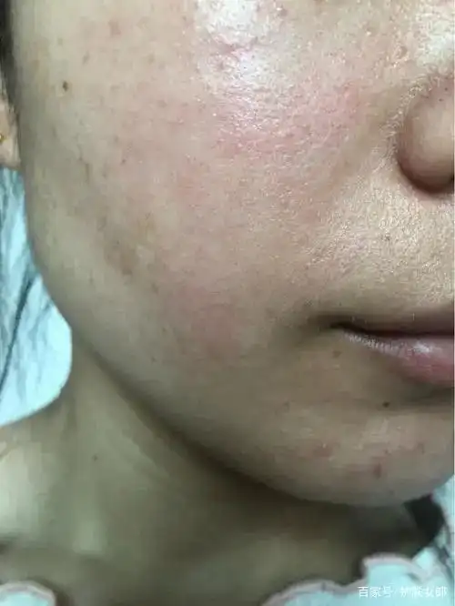 面部皮肤屏障受损这几点一定要注意