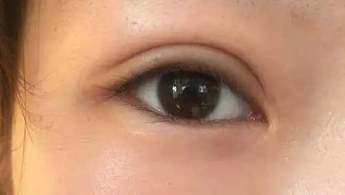 切开双眼皮 开了一点点眼角,已经四个月了 好看嘛