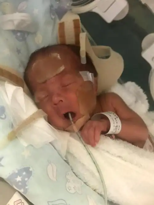 30周 4天早产儿7815小米糕成长记(day 9)_母乳_雅培怎么样_香港