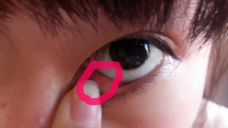 下眼皮内有个白色小疙瘩略疼.是怎么回事?