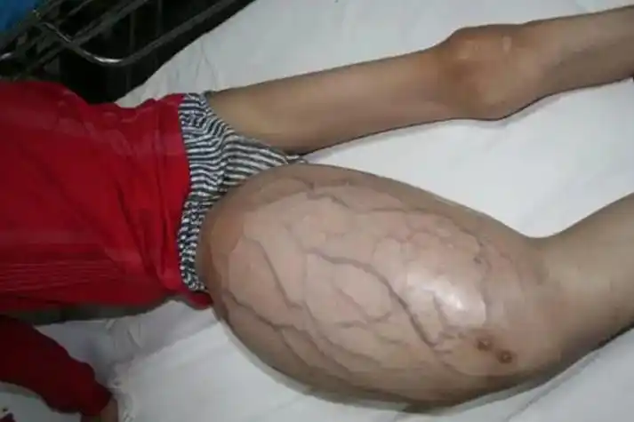 大腿淋巴肿瘤图片大全