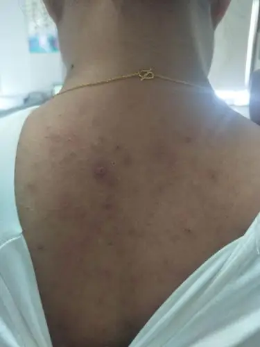 背上痘痘很痒是怎么回事