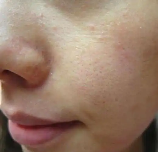 脸上毛孔粗大,出油严重?多半是有这几个坏习惯,3方法收缩毛孔