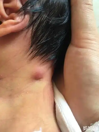 求助,宝宝18天了,脖子左边长了一个硬邦邦的疙瘩,是长在肉里面的,有木