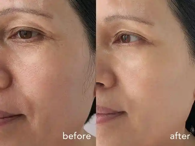 它像一剂"后悔药", 眼下细纹,法令纹淡了好多,笑起来木偶纹也不怎么