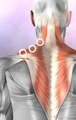 王友霞运动管理康复技术之颈部和背部疼痛元凶之一斜方肌