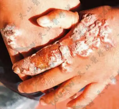 【图】佛隆那霉病(veronamycosis) - 皮肤病学 - 天山医学院