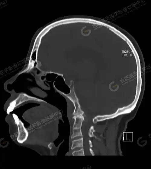 术前检查头颅ct平扫发现"颅底凹陷症"1例_测量_枕骨_形态