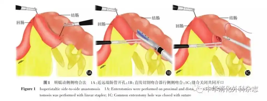 腹腔镜直线切割吻合器腔内吻合技 - 抖音