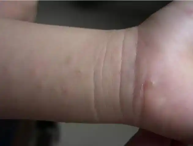 痒痒痒得了疥疮怎么办