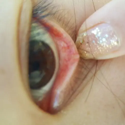 眼睛下眼睑中部长了一个白色颗粒有大半年了以为自己会好可是一直