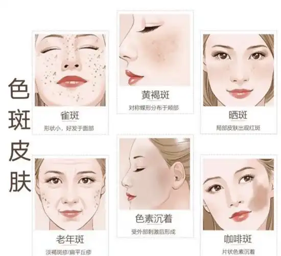 这几种斑点稍微用点心就可以改善