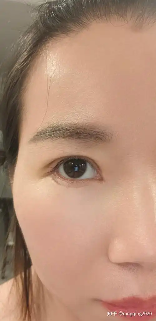 辛苦大家帮忙看看我这双眼皮做的是不是太窄了? - 知乎