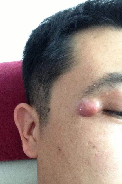 眼角长了个疙瘩图片 (16)_有来医生