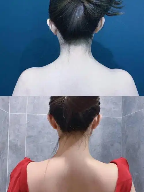 瘦肩值不值得做斜方肌太厚实解决办法75