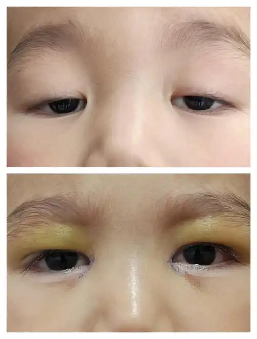 上睑下垂_发病原因_症状表现 - 好大夫在线