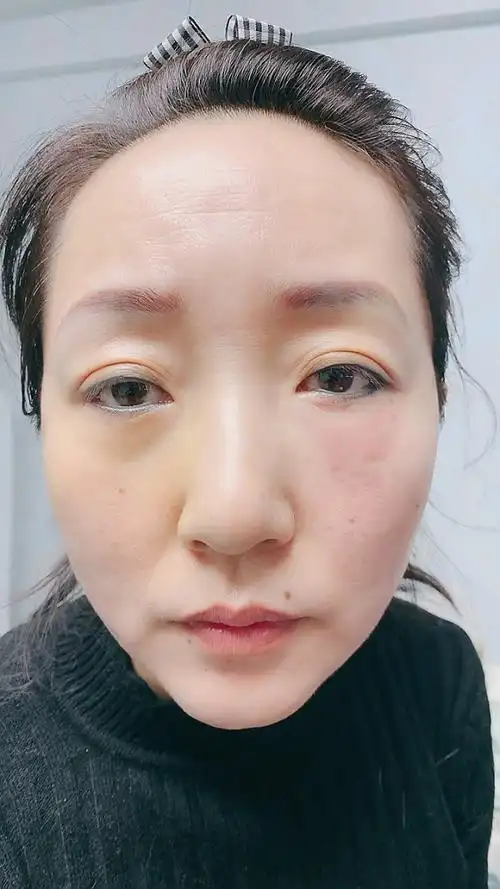 泪沟填充一侧效果