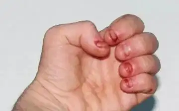 啃指甲的严重后果,小孩啃指甲的危害图片