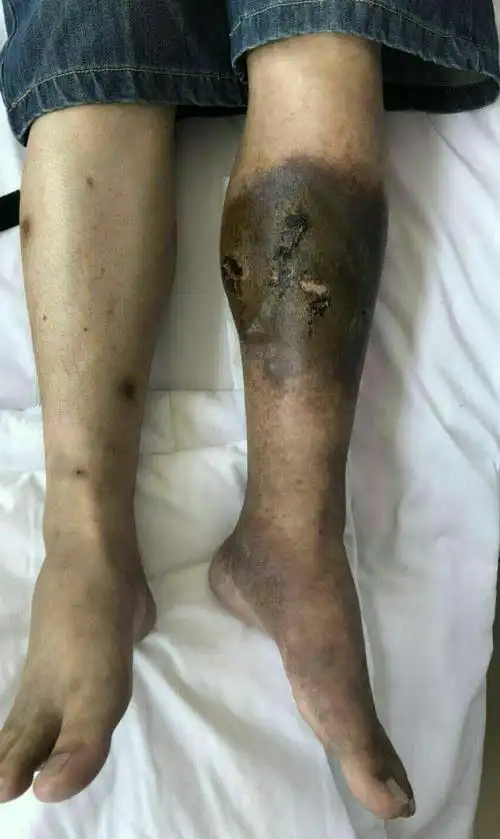 左小腿皮肤色素沉着,溃疡形成