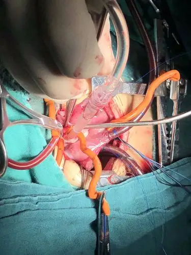 胸心外科开展巨大左心房二尖瓣置换术