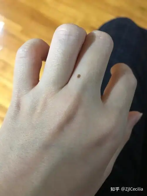 有没有手指上有痣的人? - 知乎
