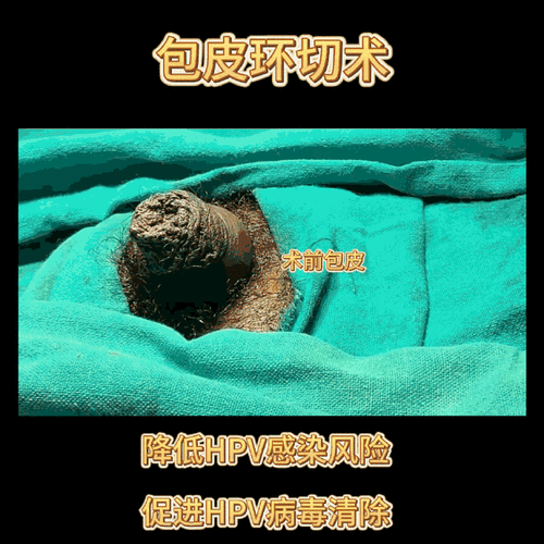【割包皮】昨天有姐妹问怎么样算包皮过长给大家找了个包皮环切术前术