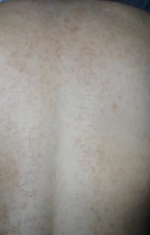 提问私信ta  展开全部 背上长很多红点,有可能是湿疹,也有可能是毛囊