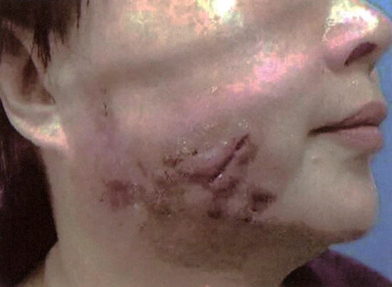 溶脂针减肥可导致全身溃烂溶脂针副作用讲解