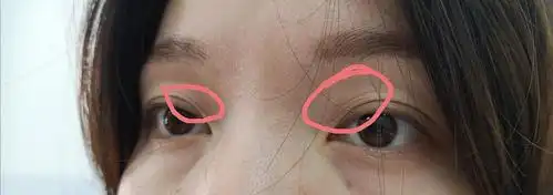 我眼皮上这是皱纹吗?