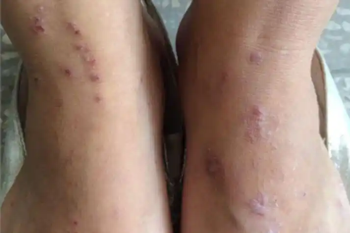 湿疹样型癣菌疹症状图