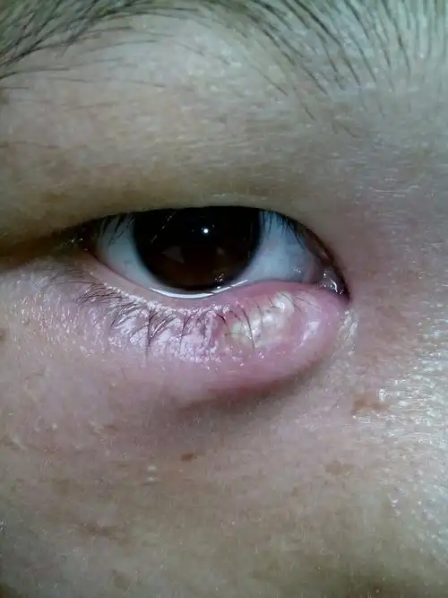 前两天睡一觉眼睛就起了个包,痛死了,哪位医生帮我看下?